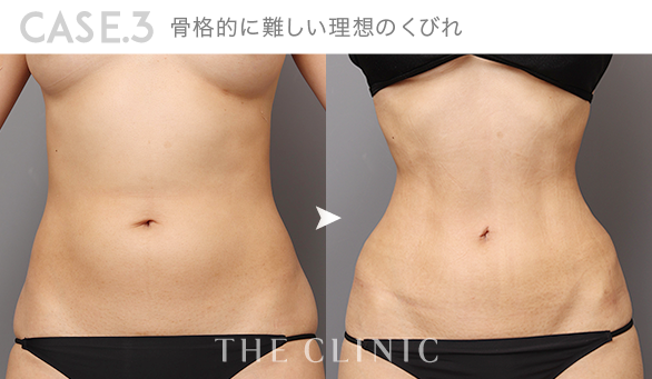 CASE.3 骨格的に難しい理想のくびれ