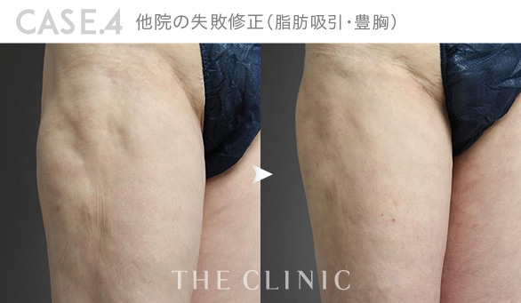 CASE.4 他院の失敗修正（脂肪吸引・豊胸）