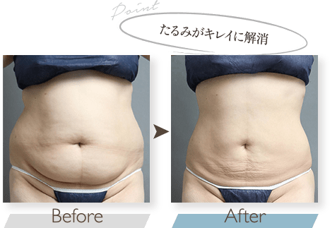 お腹のたるみがキレイに解消