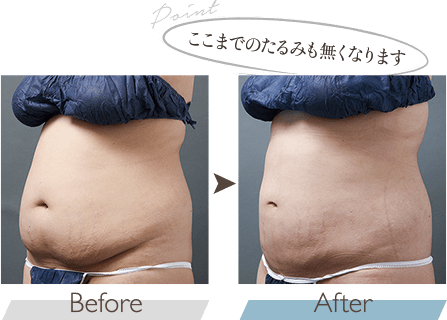 ここまでのお腹のたるみもなくなります
