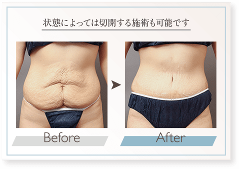 皮膚の余り具合によっては皮膚切除も可能です