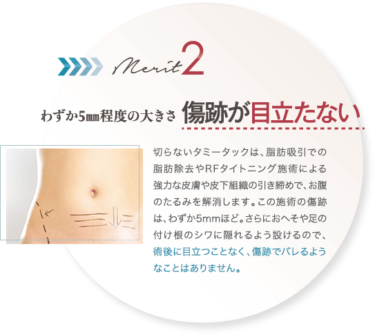 わずか5㎜程度の大きさ｜傷跡が目立たない｜切らないタミータックは、脂肪吸引での脂肪除去やRFタイトニング施術による強力な皮膚や皮下組織の引き締めで、お腹のたるみを解消します。この施術の傷跡は、わずか5mmほど。さらにおへそや足の付け根のシワに隠れるよう設けるので、術後に目立つことなく、傷跡でバレるようなことはありません。