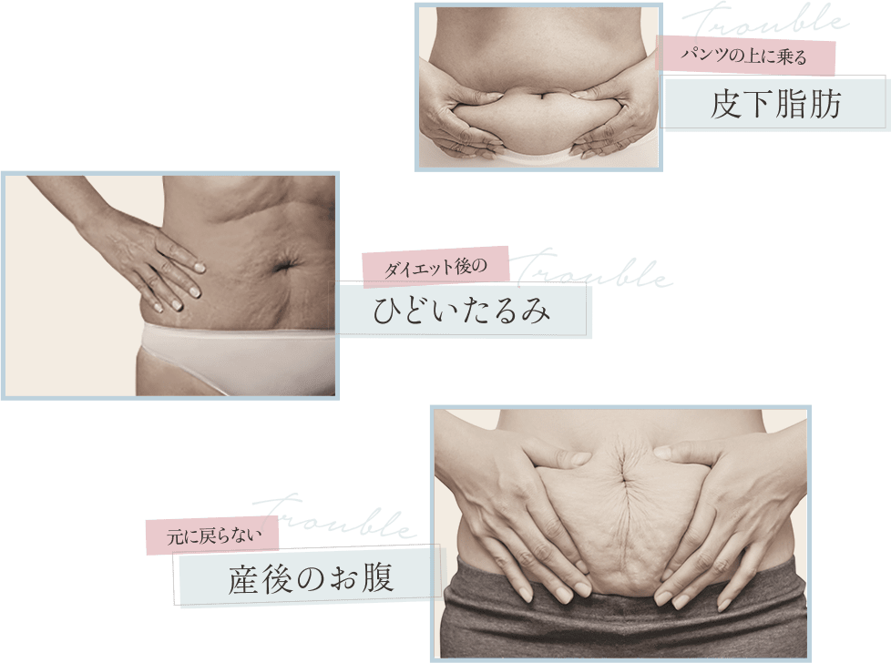 パンツに乗るお腹の皮下脂肪｜ダイエット後に余った皮膚｜元に戻らない産後のお腹のたるみ