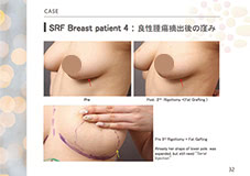 豊胸に関する学会発表資料(抜粋)