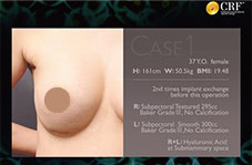 コンデンスリッチ豊胸に関する学会発表スライドの抜粋(2016年/大橋昌敬医師)