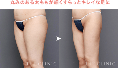 丸みのある太ももが細くすらっとキレイな足に