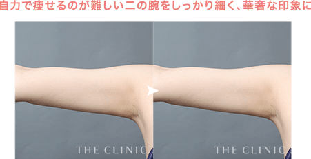 自力で痩せるのが難しい二の腕をしっかり細く、華奢な印象に