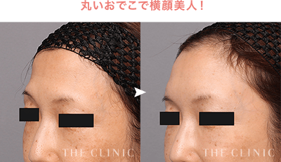 丸いおでこで横顔美人！［コンデンスリッチファット（おでこ）］