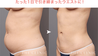 たった1日で引き締まったウエストに！［ベイザー脂肪吸引：全腹部3部位+腰］