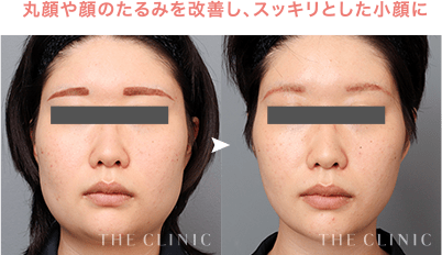 丸顔や顔のたるみを改善し、スッキリとした小顔に