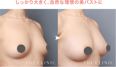 しっかり大きく、自然な理想の美バストに