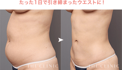 たった1日で引き締まったウエストに！［ベイザー脂肪吸引：全腹部3部位+腰］