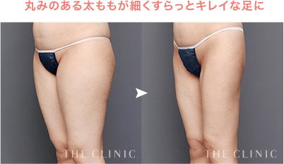丸みのある太ももが細くすらっとキレイな足に