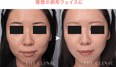 理想の卵形フェイスに［ベイザー脂肪吸引：頬+あご下］