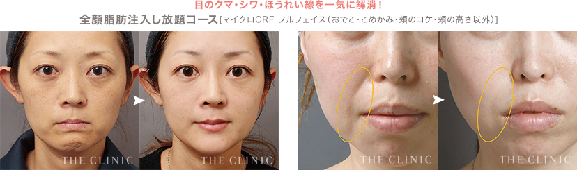 全顔脂肪注入し放題コース