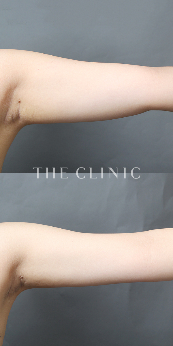 二の腕のベイザー脂肪吸引（25歳女性）の術前・術後写真