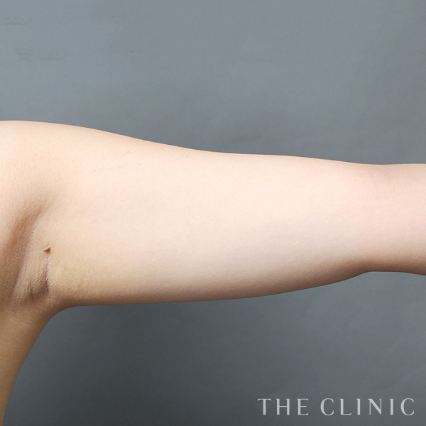二の腕のベイザー脂肪吸引（25歳女性）の術前写真