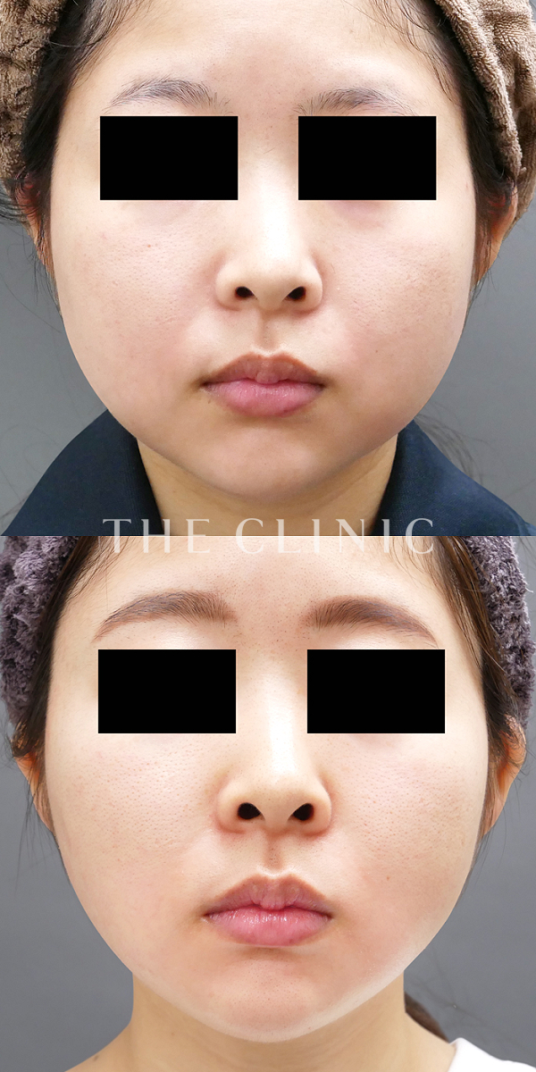 頰／顎のベイザー脂肪吸引（24歳女性）の術前・術後写真