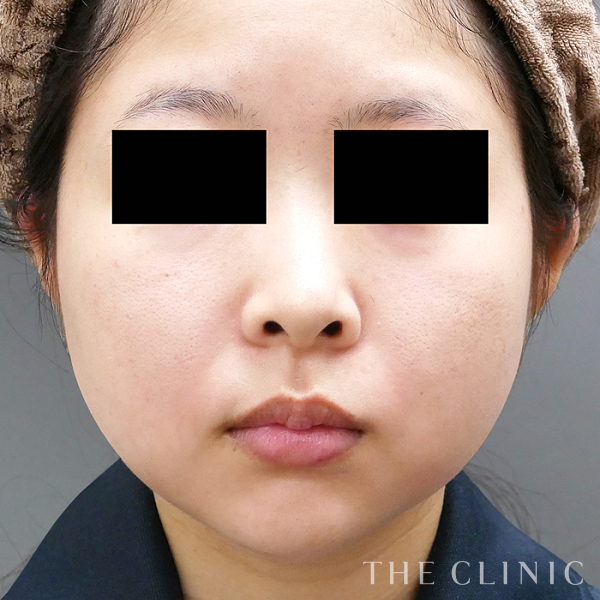 頰／顎のベイザー脂肪吸引（24歳女性）の術前写真