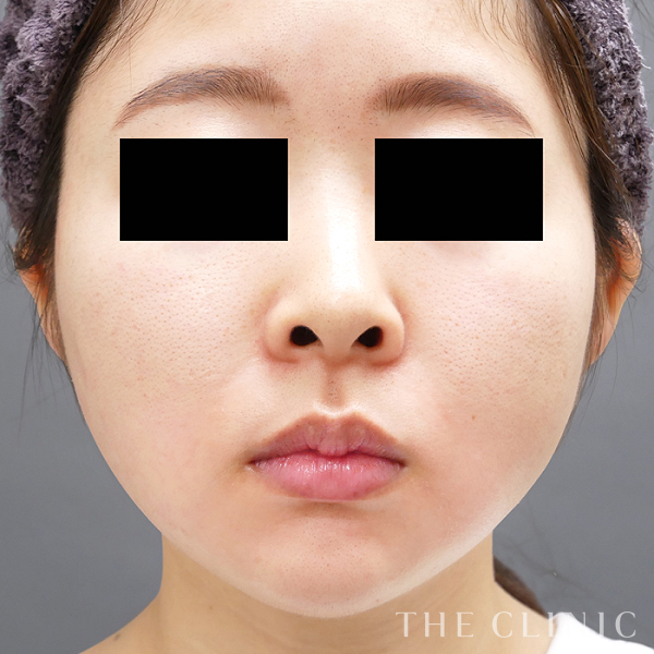 頰／顎のベイザー脂肪吸引（24歳女性）の術後写真