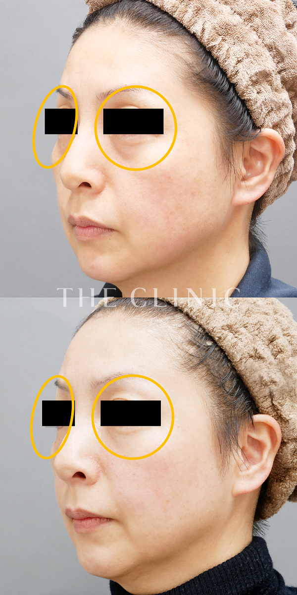 目の上のくぼみ・こけた頬・法令線のマイクロCRF注入(顔の脂肪注入)（45歳女性）の術前・術後写真