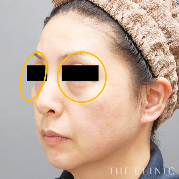 目の上のくぼみ・こけた頬・法令線のマイクロCRF注入(顔の脂肪注入)（45歳女性）の術前写真