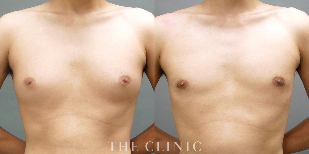 ベイザー脂肪吸引の術前／術後