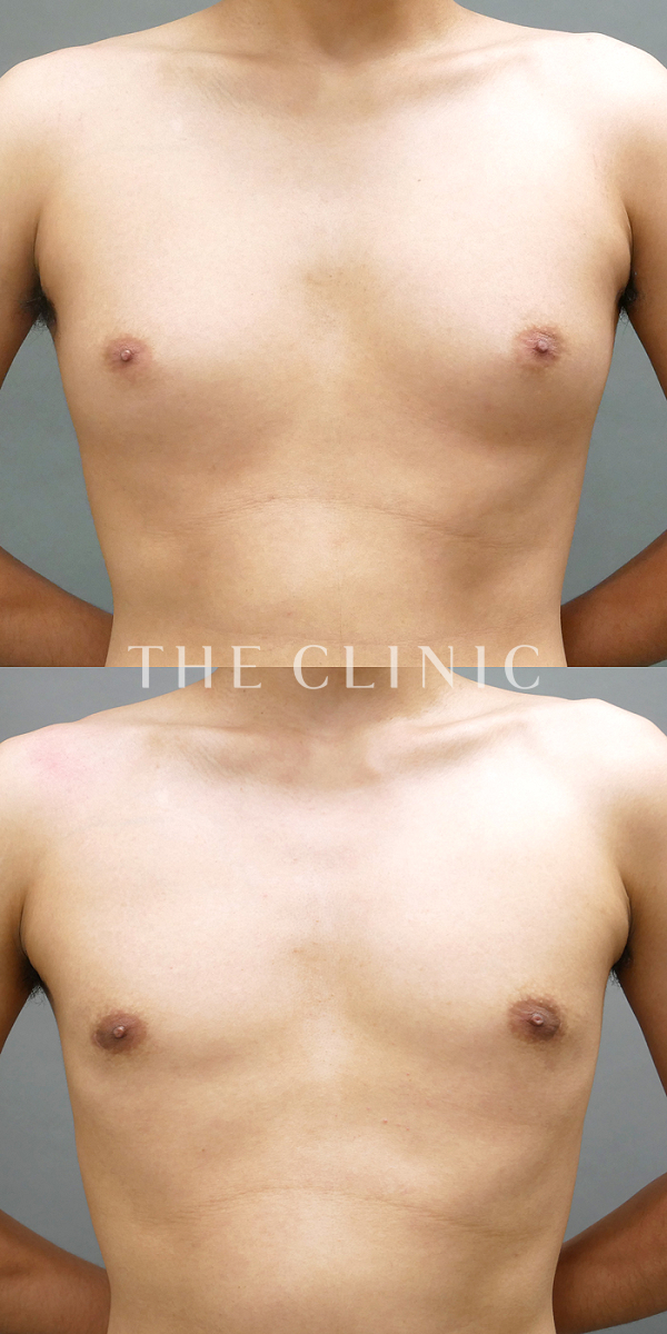 真性女性化乳房のベイザー脂肪吸引（28歳男性）の術前・術後写真