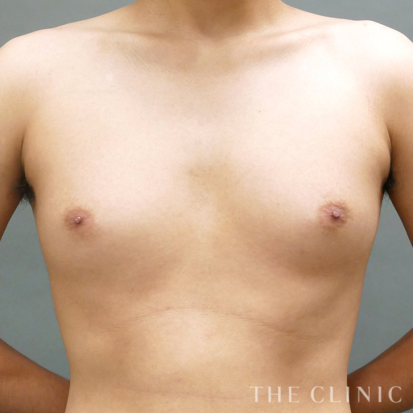真性女性化乳房のベイザー脂肪吸引（28歳男性）の術前写真