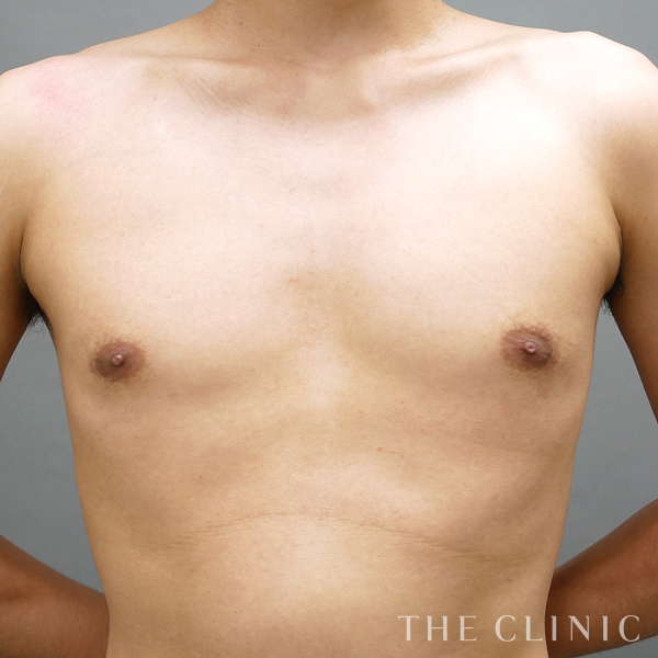 真性女性化乳房のベイザー脂肪吸引（28歳男性）の術後写真