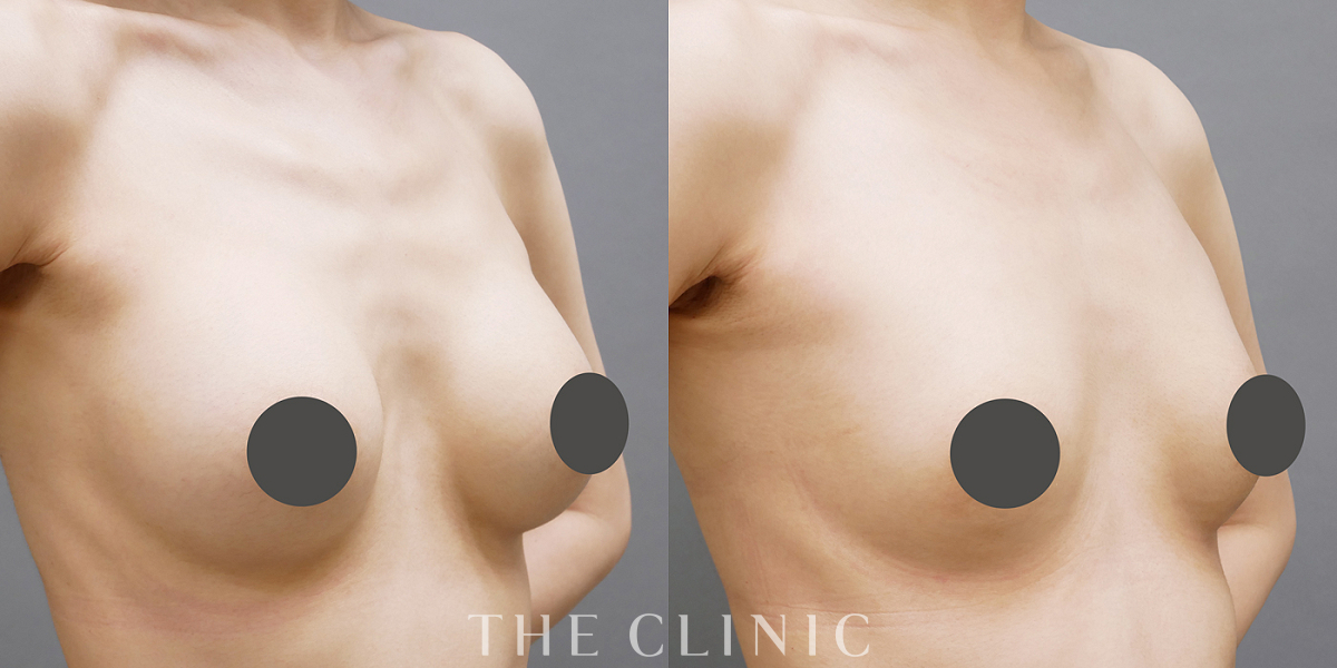 豊胸シリコンバッグ除去の術前／術後