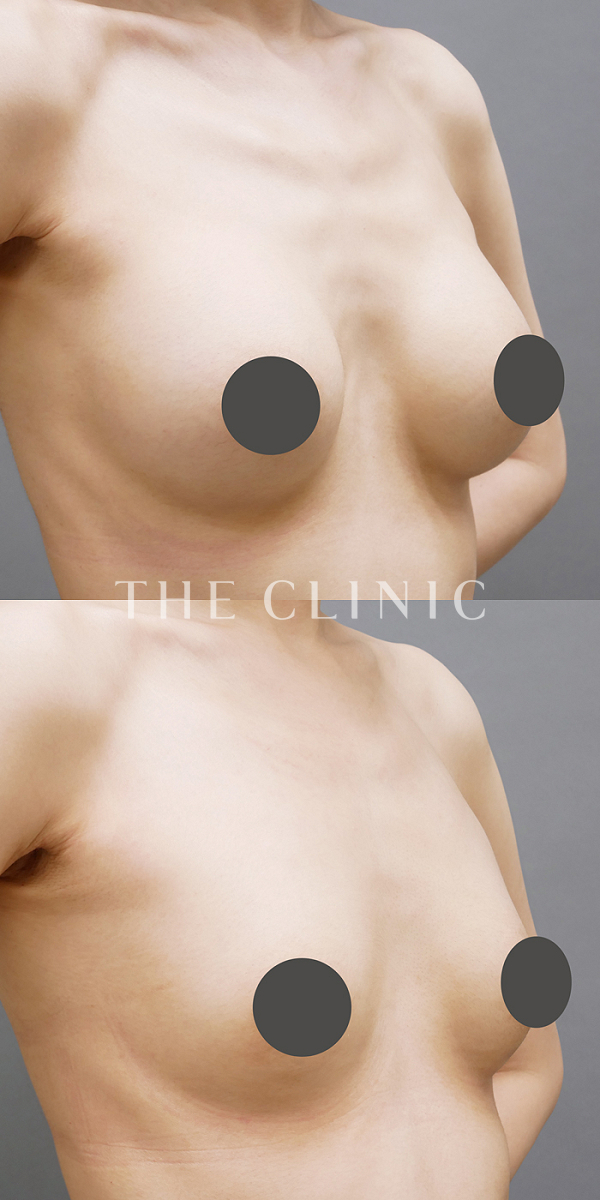 シリコンバッグ抜去の豊胸シリコンバッグ除去（37歳女性）の術前・術後写真