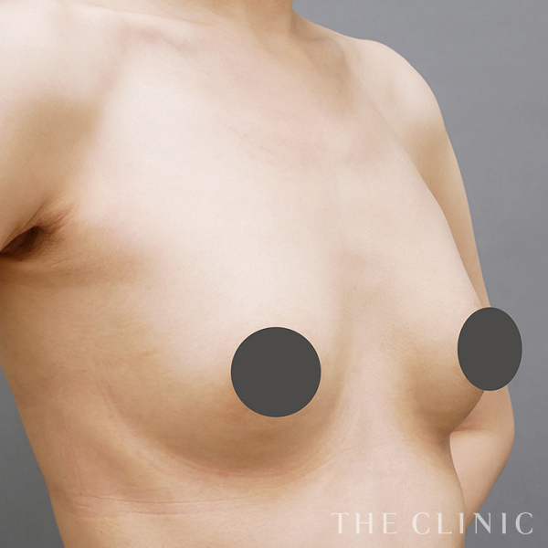 シリコンバッグ抜去の豊胸シリコンバッグ除去（37歳女性）の術後写真