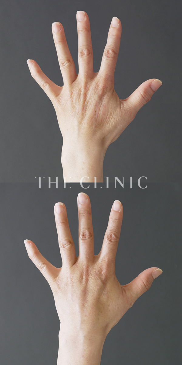 手のシワの手の甲への脂肪注入(ハンドリバイブ)（60歳女性）の術前・術後写真