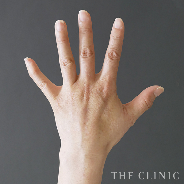 手のシワの手の甲への脂肪注入(ハンドリバイブ)（60歳女性）の術後写真