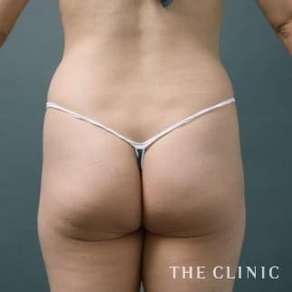 【THE CLINIC 症例画像】No.102_1_お尻_ヒップメイク by 360脂肪吸引®