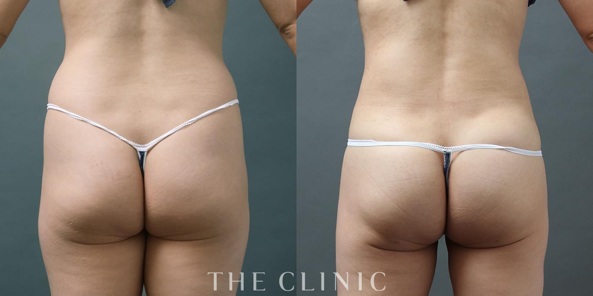 ヒップメイク by 360脂肪吸引®の術前／術後