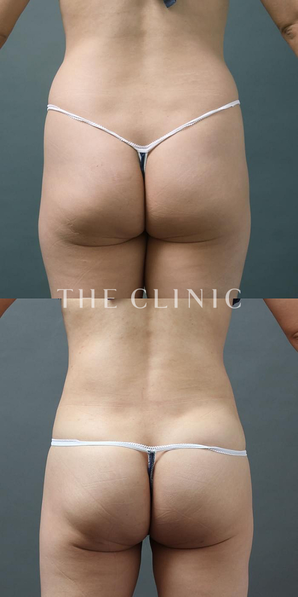 お尻・ボリュームアップのヒップメイク by 360脂肪吸引®（36歳女性）の術前・術後写真