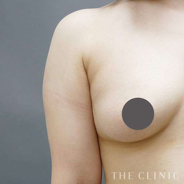 二の腕のベイザー脂肪吸引（21歳女性）の術前写真