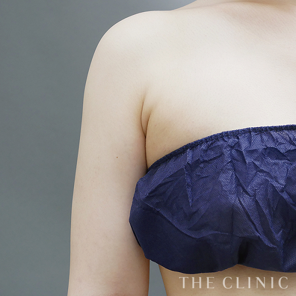 二の腕のベイザー脂肪吸引（21歳女性）の術後写真