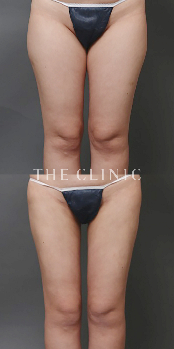 太ももの脂肪症例（30歳女性）の術前・術後写真