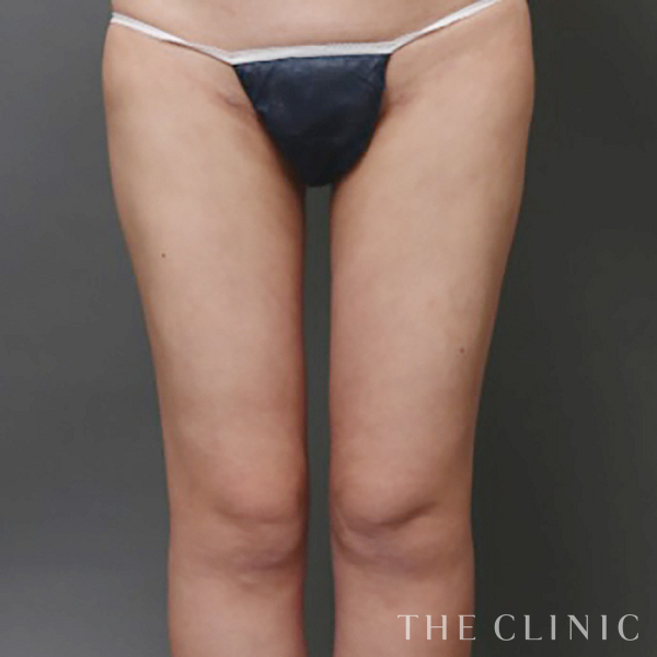 太ももの脂肪症例（30歳女性）の術後写真