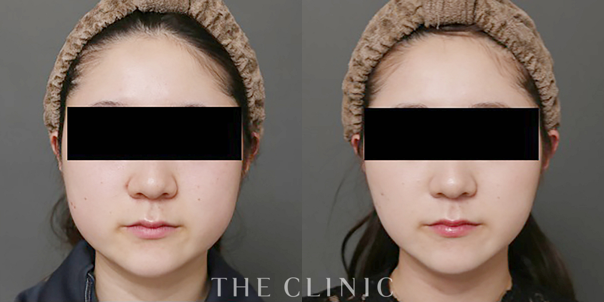 ベイザー脂肪吸引の術前／術後