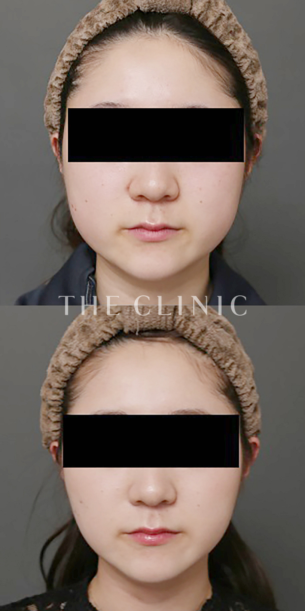頰／顎のベイザー脂肪吸引（28歳女性）の術前・術後写真