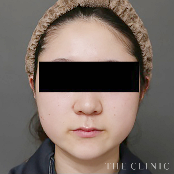 頰／顎のベイザー脂肪吸引（28歳女性）の術前写真