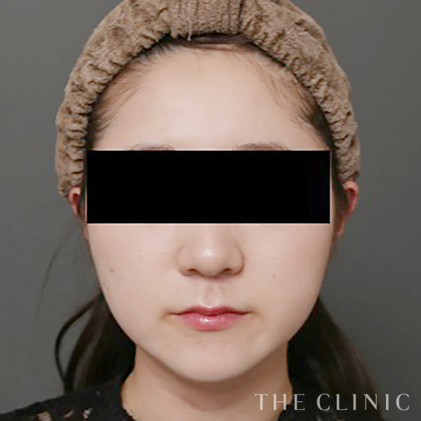 頰／顎のベイザー脂肪吸引（28歳女性）の術後写真