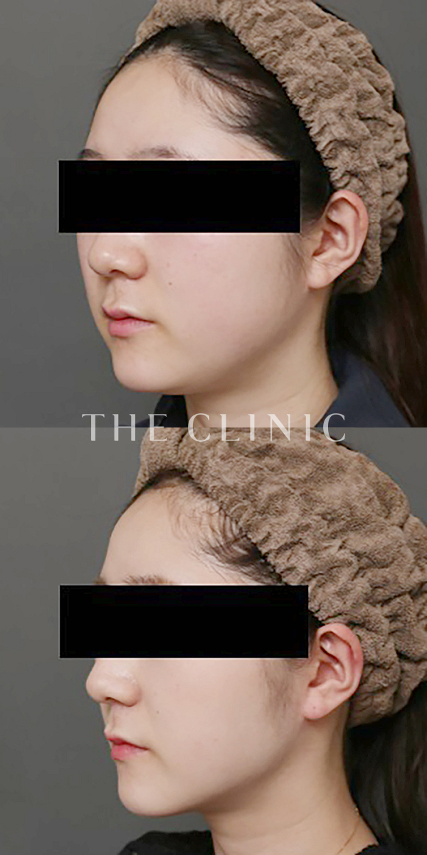 頰／顎のベイザー脂肪吸引（28歳女性）の術前・術後写真