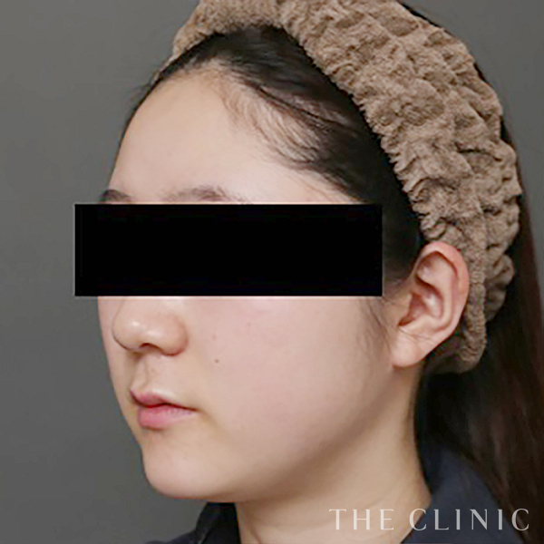 頰／顎のベイザー脂肪吸引（28歳女性）の術前写真