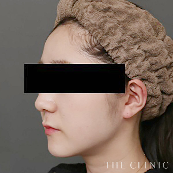 頰／顎のベイザー脂肪吸引（28歳女性）の術後写真