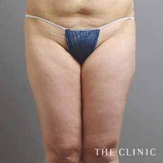【THE CLINIC 症例画像】No.1044_1_太もも_ベイザー脂肪吸引